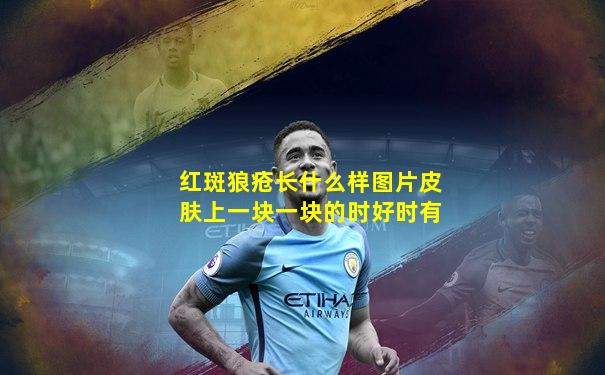 红斑狼疮长什么样图片皮肤上一块一块的时好时有